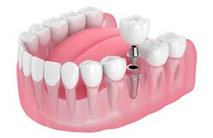 Digital Dental Implants